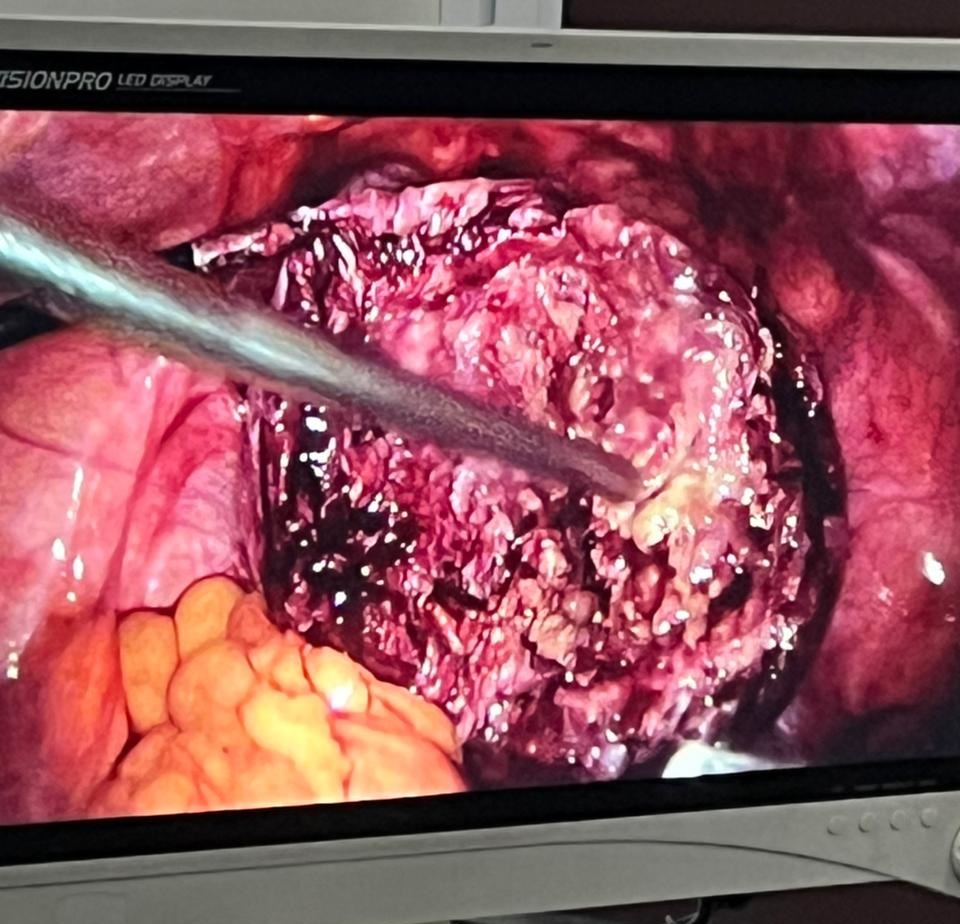 Successful Removal of Large Uterine Fibroid (10 cm) Laparoscopically by Dr. Deepshikha Dwivedi